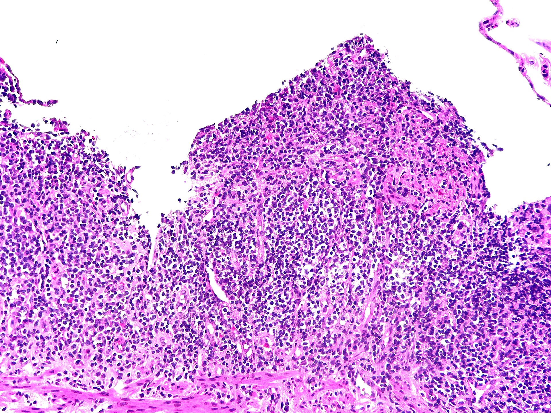 A histopathology slide of severe ulcerative colitis, showing inflamed bowel mucosa under the microscope.